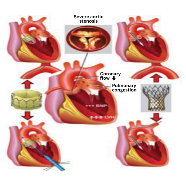 Image to show a new valve placed inside the heart