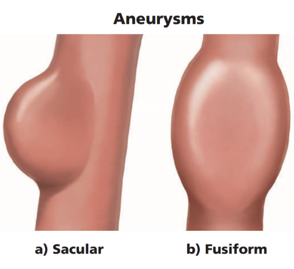 image of aneurysms
