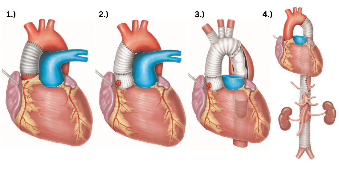 types of aortic surgery images