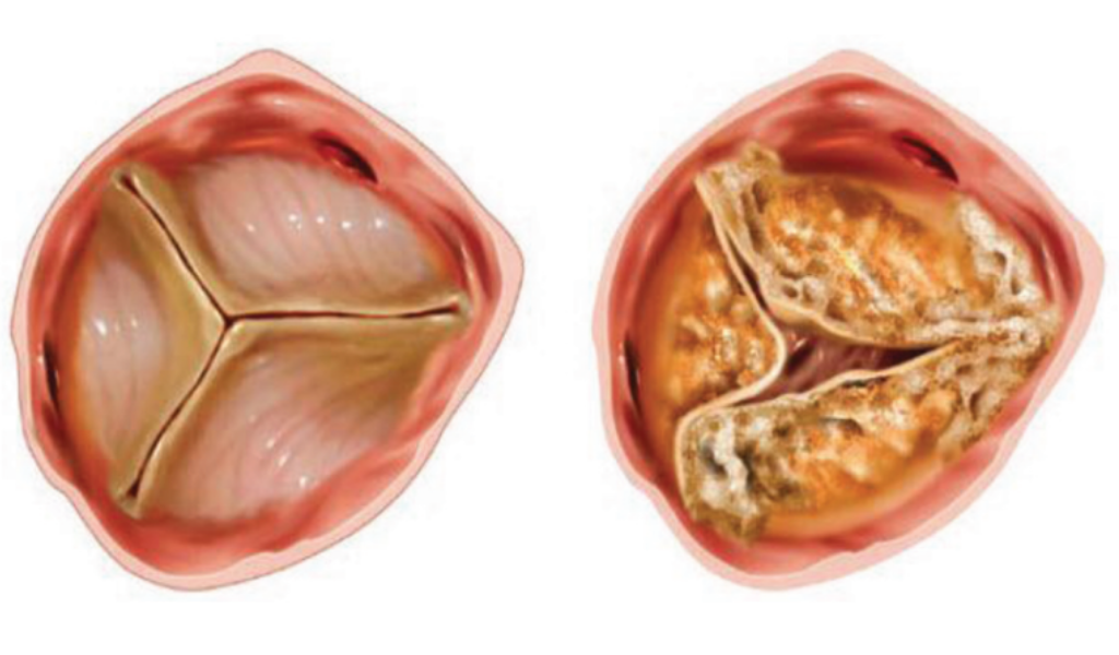 Normal and stenotic valve image